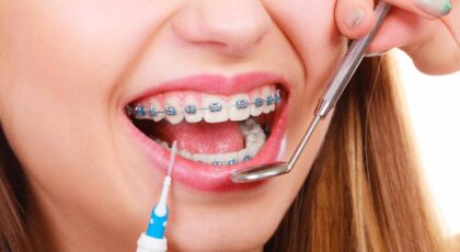 6 Signs You Need Braces Asap