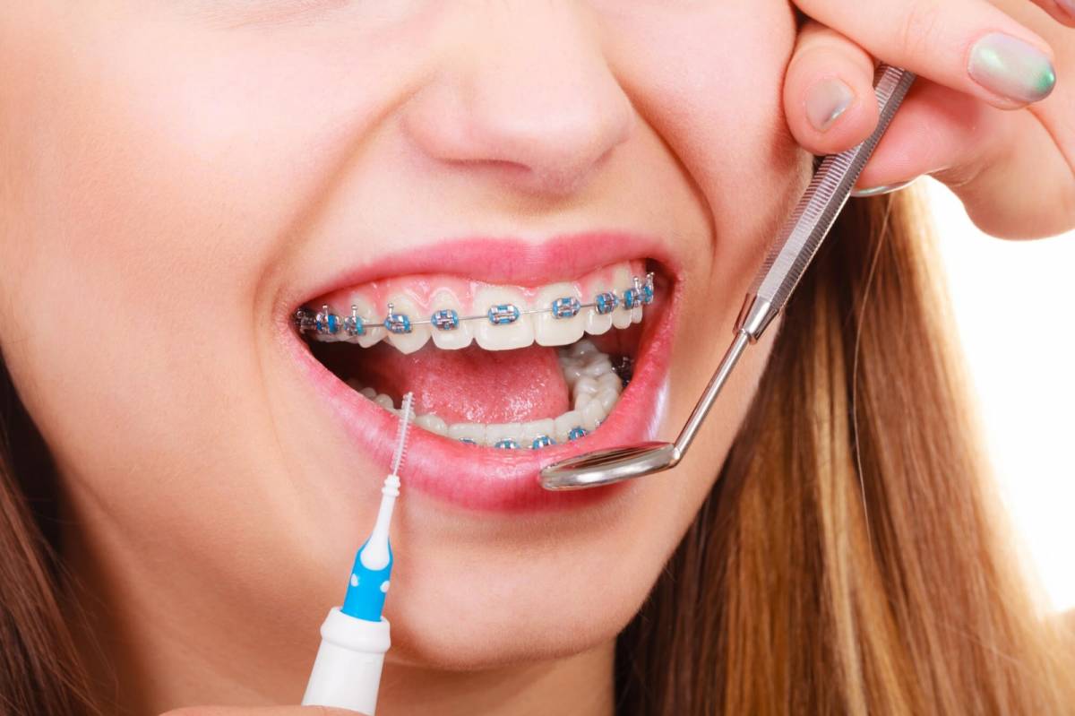 6 Signs You Need Braces Asap