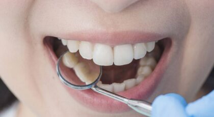 What To Know About Teeth Shifting